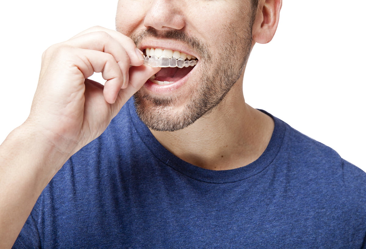 Invisalign | Somerset Dental on James