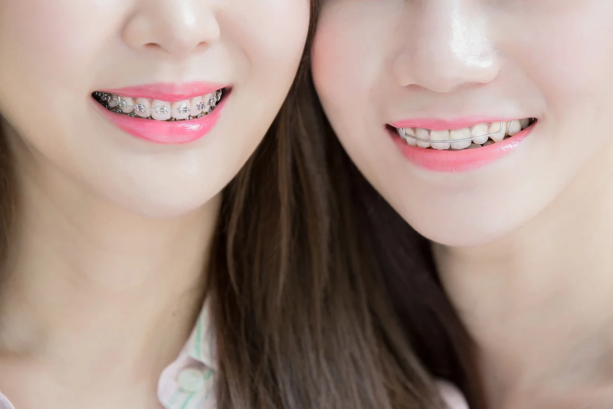 close up of woman tooth Braces | Somerset Dental on James