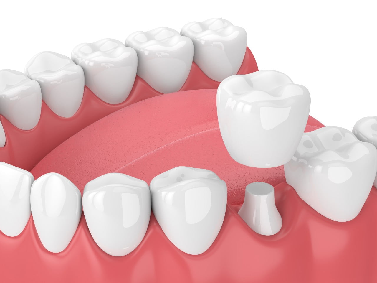 Dental-Crowns-3D Dental Crowns | Somerset Dental on James