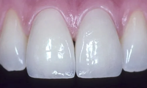 Veneers before and after