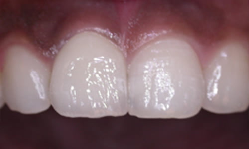 Dental Implants After