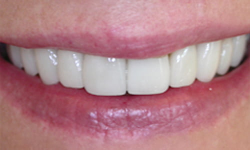 Veneers before and after