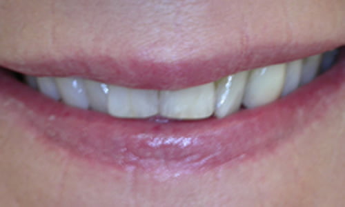 Veneers before and after