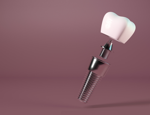 The Surprising Benefits of Dental Implants for Oral Health