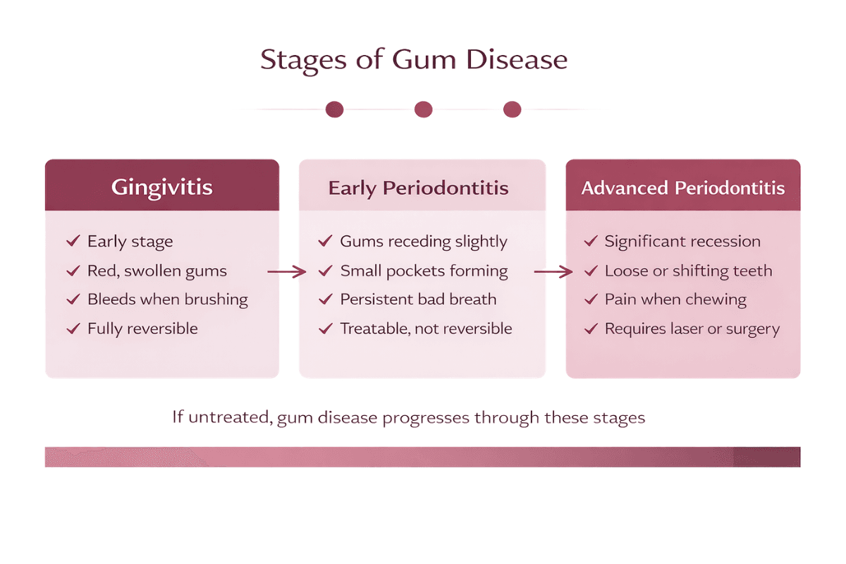 Diagram showing the three stages of gum disease: gingivitis, early periodontitis, and advanced periodontitis.