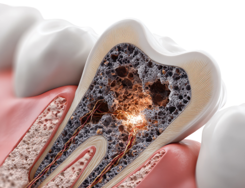 Tooth Decay Treatment and Prevention: 5 Tips and FAQs