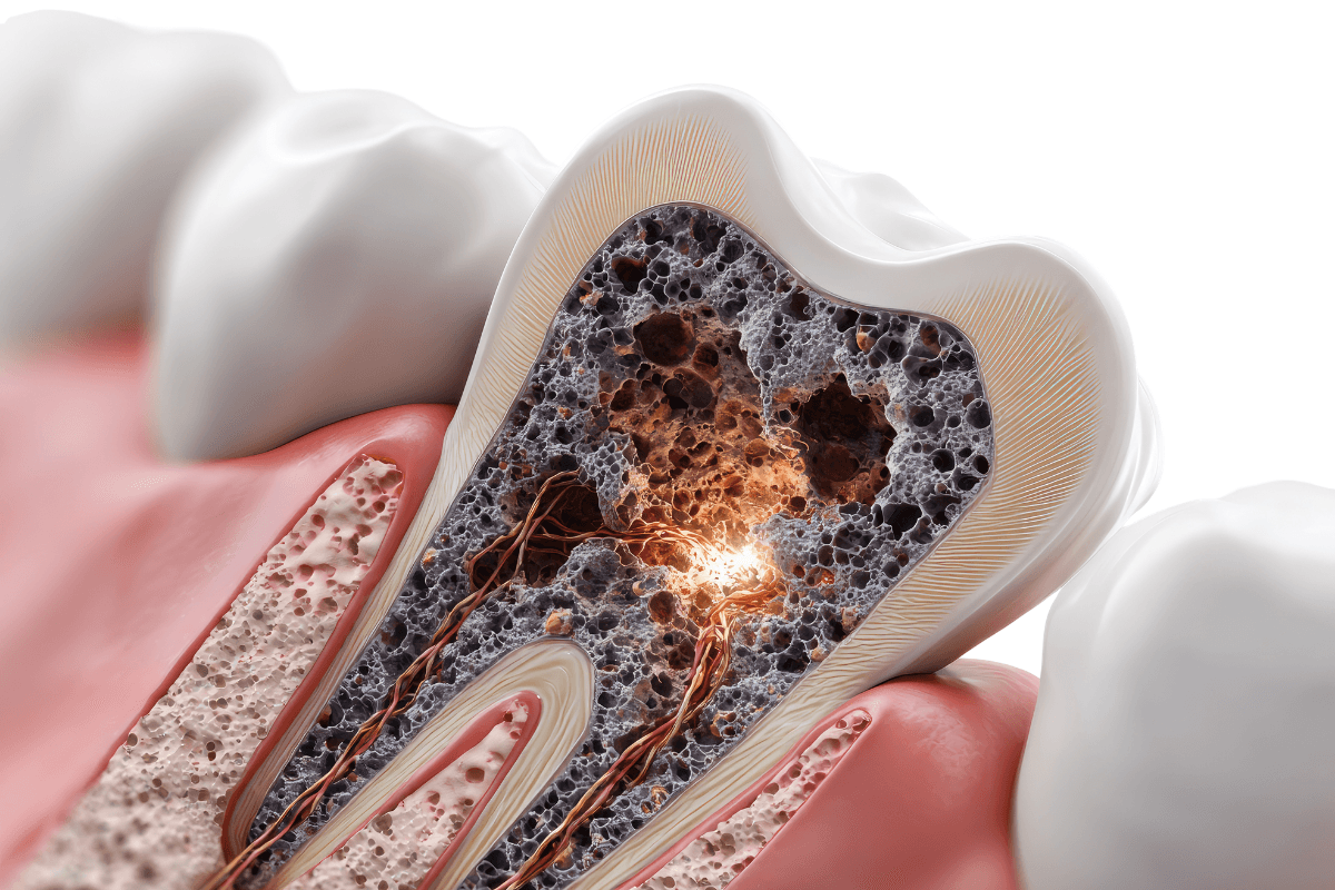 A 3D illustration showing a cross-section of a tooth with advanced decay affecting the inner structure.