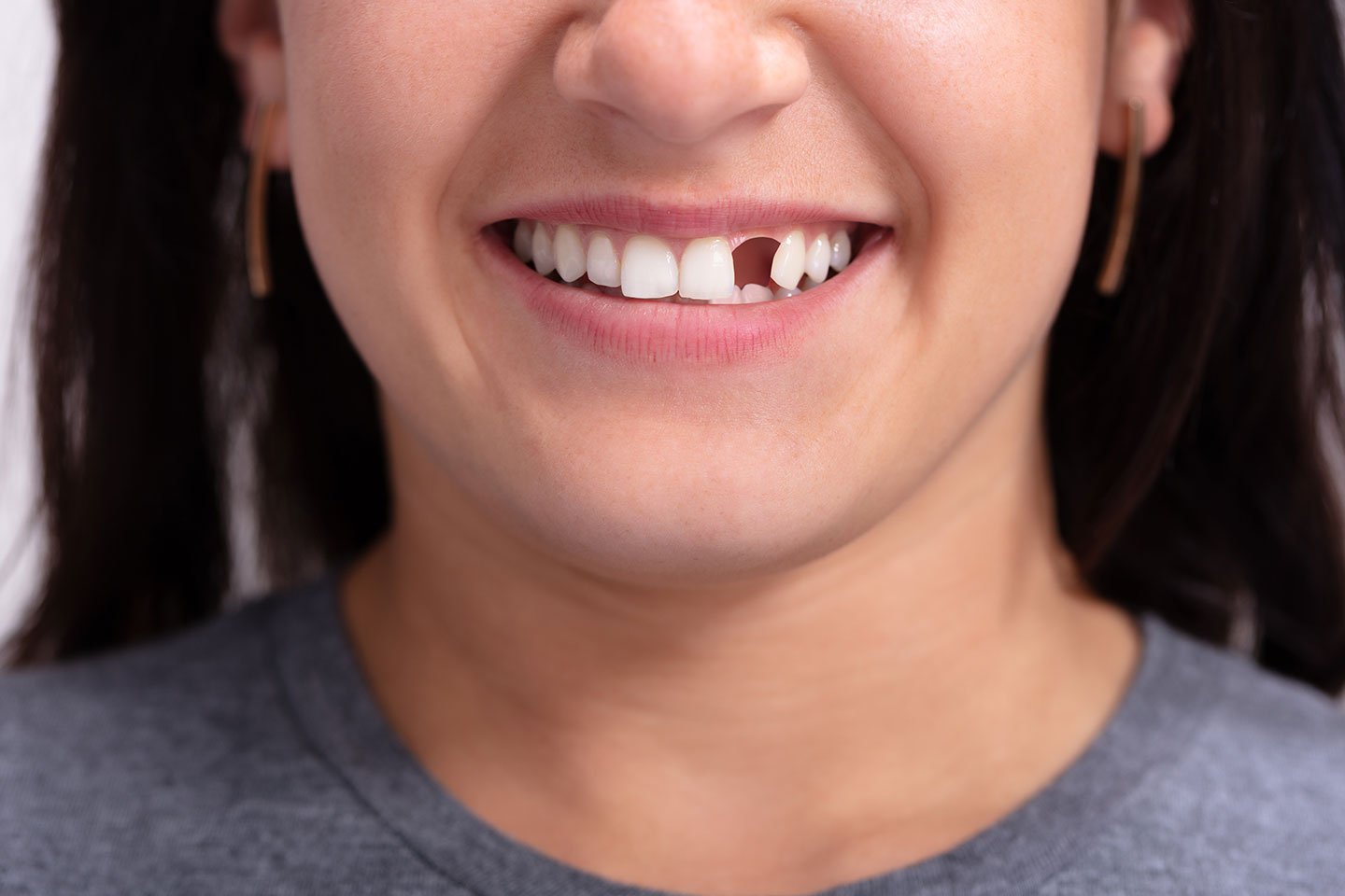 Replacing Missing Teeth