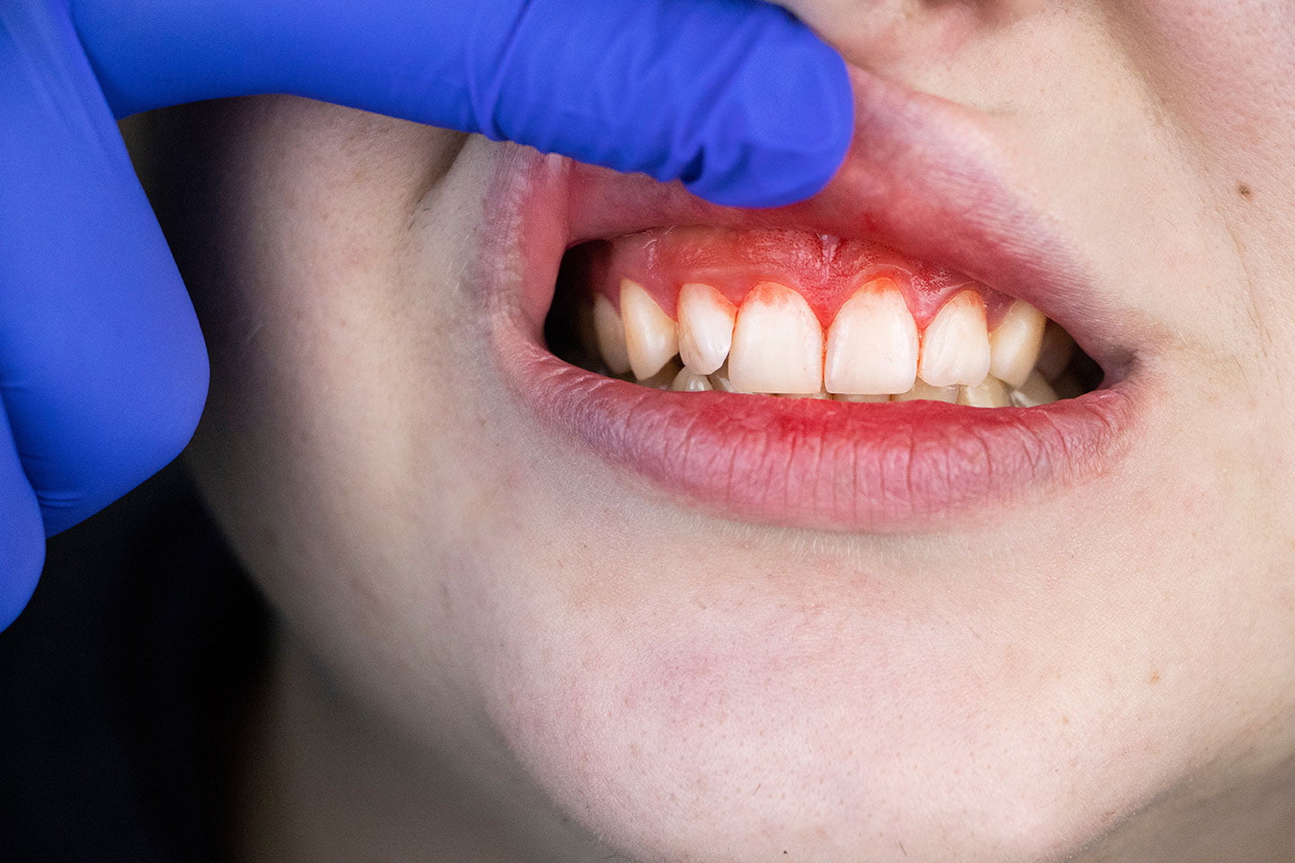 The 5 Stages of Gum Disease: Signs, Symptoms, and Treatment - Old