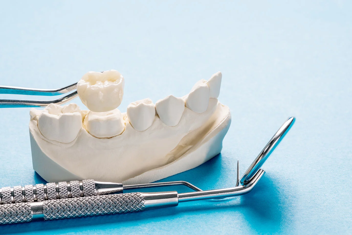 What is a Dental Crown