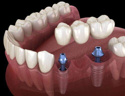 Dental Bridge vs. Implant — Pros and Cons and How to Choose