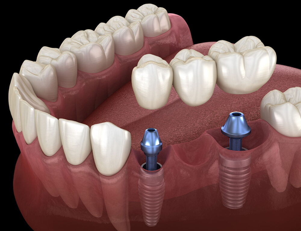 Types of Dental Crowns: Pros & Cons | Somerset Dental