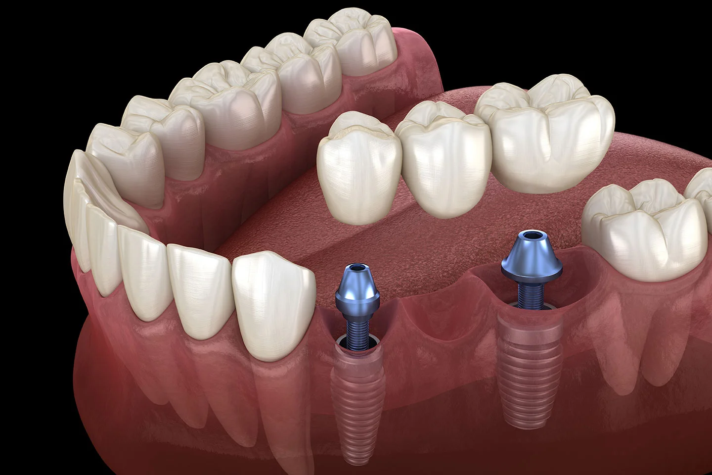 Dental Bridge vs Implant - Pros and Cons and How To Choose