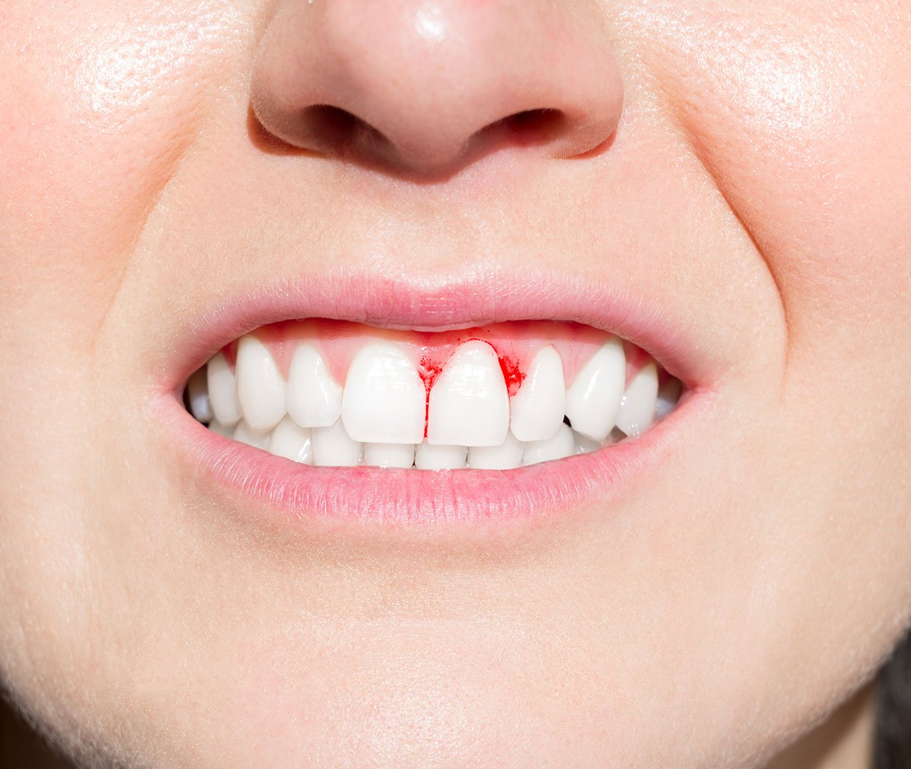 woman-mouth-bleeding-gum-disease