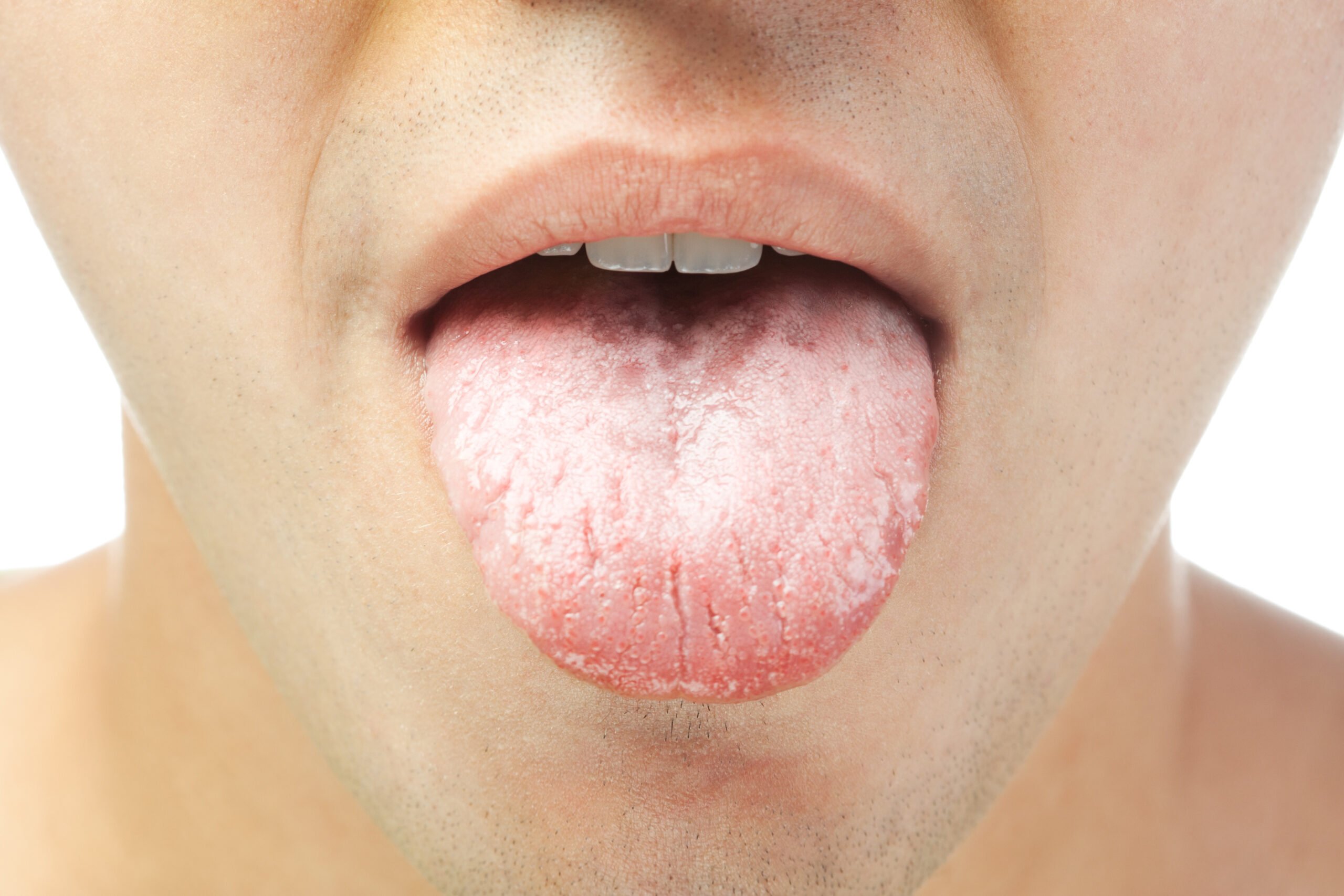 Causes and Symptoms of Dry Mouth