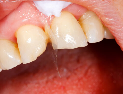 Cracked Tooth Repair Options: From Dental Bonding to Crowns and Beyond