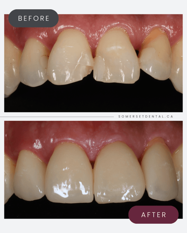 Types of Dental Crowns: Pros & Cons | Somerset Dental