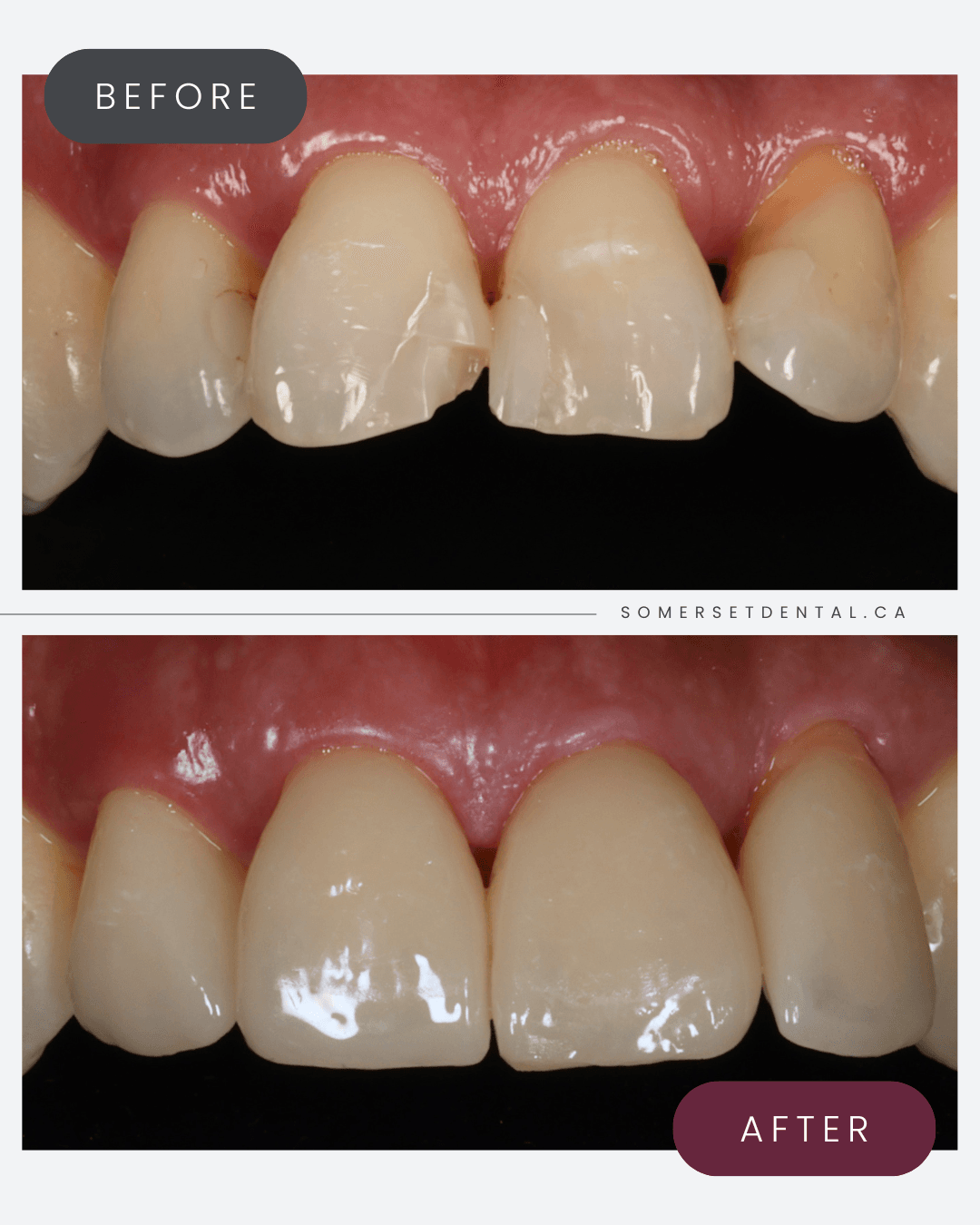 Before and after same-day dental crowns on four front teeth at Somerset Dental on James in Calgary SW