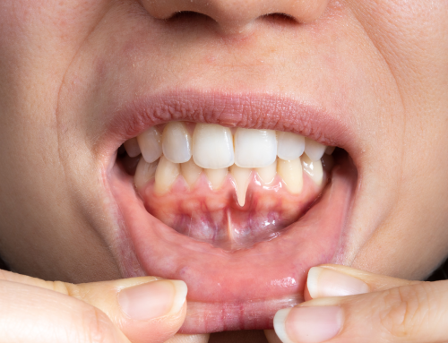 Receding Gums: When to Treat vs. When to Monitor