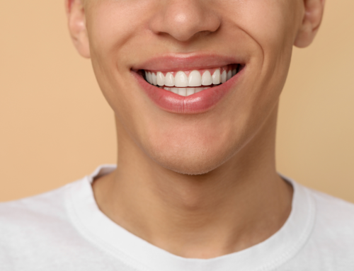 How Long Do Veneers Last?